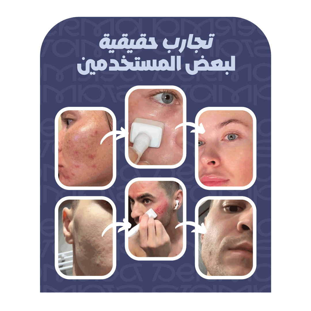 ديرما ستامب لإصلاح البشرة والتخلص من آثار الندبات بفعالية